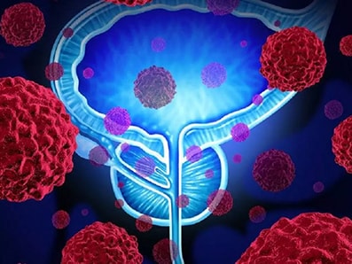 Tumore della prostata, nuovo studio sui benefici di darolutamide