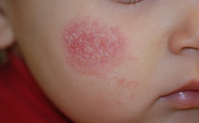Quanto pesa sui bambini la dermatite atopica?
