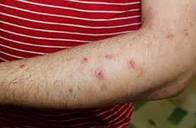 EADV 2022: Dupilumab migliora i sintomi della prurigo nodularis
