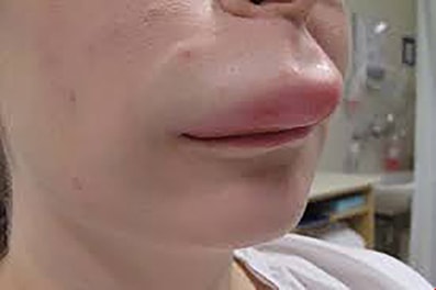 Garadacimab, risultati positivi in pazienti con angioedema ereditario (HAE)