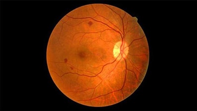 Approvato dalla CE il primo anticorpo bispecifico per l’occhio