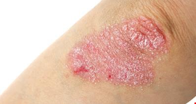 Psoriasi, nuovi dati a lungo termine su deucravacitinib di BMS