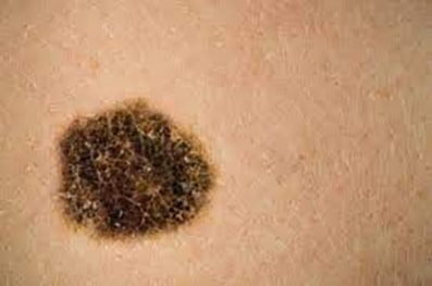 Melanoma avanzato, ok dalla CE per associazione BMS nivolumab-LAG-3