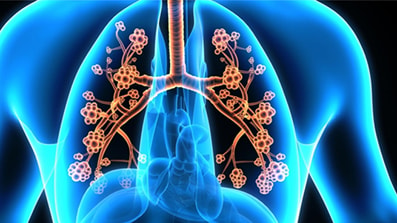 Approvato in UE tezepelumab di AZ per l’asma grave