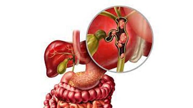 Colangiocarcinoma: stop a diagnosi casuali, serve il registro dei centri