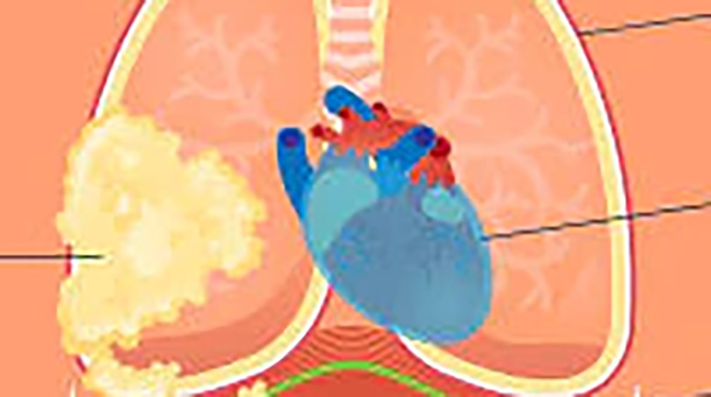 Mesotelioma: Aifa approva una nuova terapia dopo oltre 15 anni