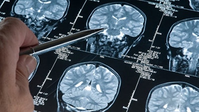 Ozanimod per prevenire l’atrofia cerebrale nella sclerosi multipla