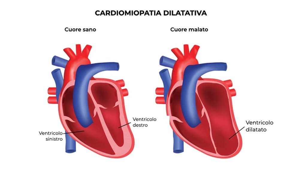 Cardiomiopatia ipertrofica ostruttiva: in Italia oltre 100 mila casi senza diagnosi