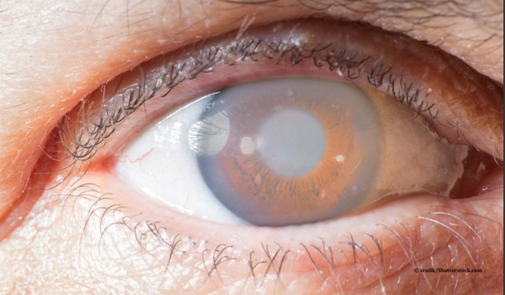 EpiColin, il supporto completo nel trattamento del glaucoma