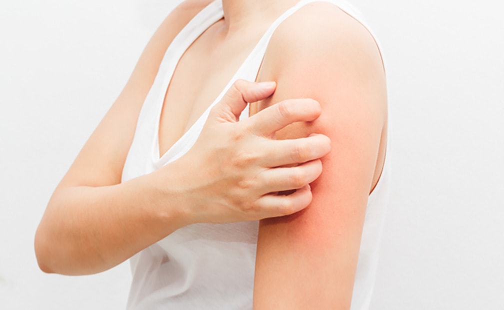 La Commissione Europea approva dupilumab per la prurigo nodulare