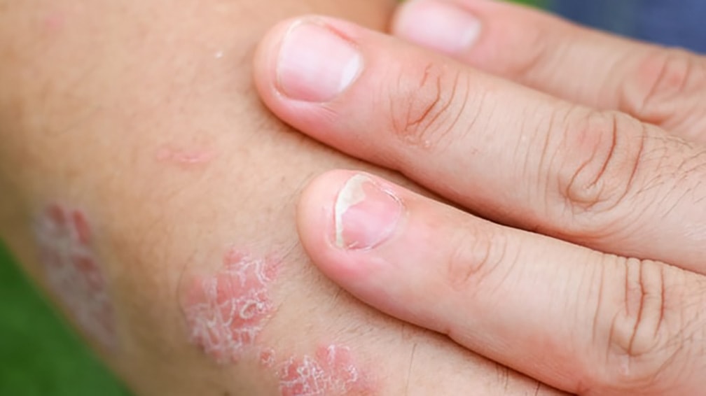 Ok di AIFA a risankizumab per l’artrite psoriasica attiva negli adulti