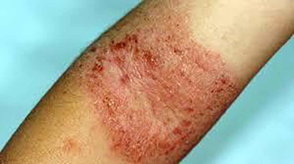 Dermatite atopica severa: il CHMP raccomanda dupilumab di Sanofi