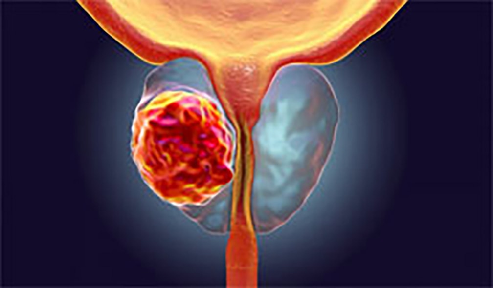 Tumore della prostata: raccomandato dal CHMP darolutamide di Bayer