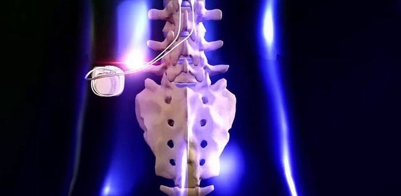 Un neurostimolatore per tornare a camminare