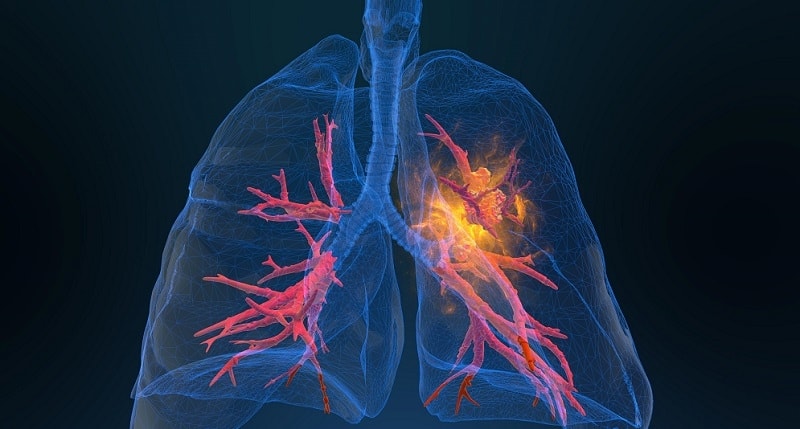 Polmone, una mutazione amica dell’immunoterapia