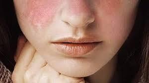 Lupus eritematoso sistemico, risultati positivi di anifrolumab per via sottocutanea
