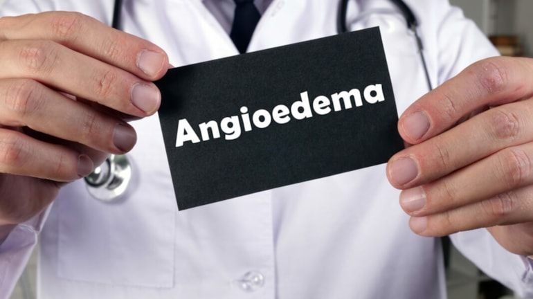 Ok Aifa all’estensione dell’indicazione pediatrica di Lanadelumab per l’Angioedema ereditario