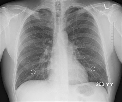 Nuova terapia per la fibrosi polmonare idiopatica e la fibrosi polmonare progressiva