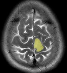 Glioma IDH-mutato, nasce in Piemonte il nuovo modello di presa in carico