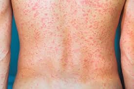 L’orticaria cronica spontanea costa ogni anno oltre 4.200 euro a paziente