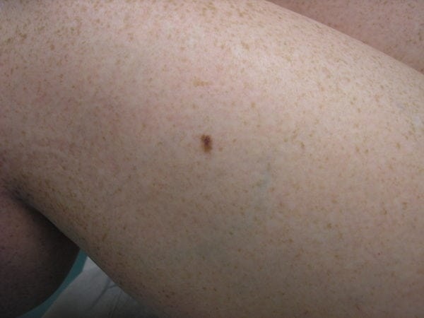 Una terapia salvavita per la pelle